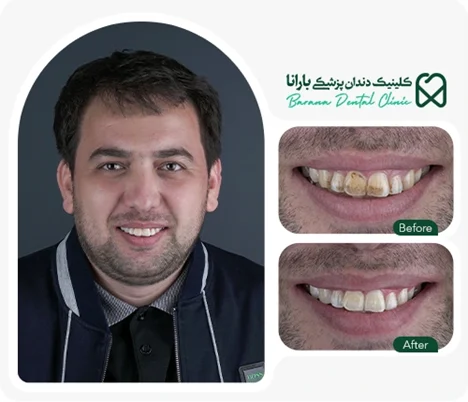 تفاوت بلیچینگ کودکان و بزرگسالان