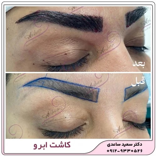 هزینه کاشت ابرو طبیعی در سال ۱۴۰۳ : بررسی کامل از دیدگاه پزشکی و زیبایی